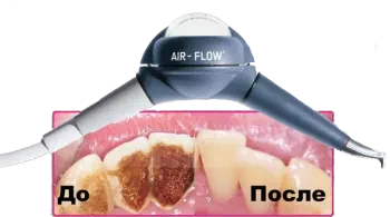 Отбеливание зубов Air-Flow